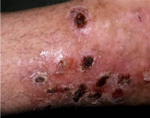 Cellulitis, Erysipelas, Impetigo – Markenzie Jean-baptiste Physician ...